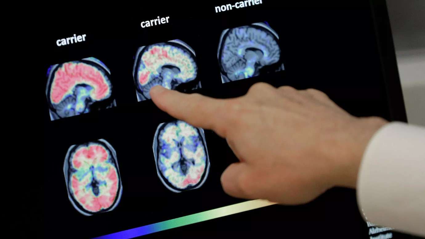 Rusia desarrolla dispositivo para tratamiento del alzhéimer